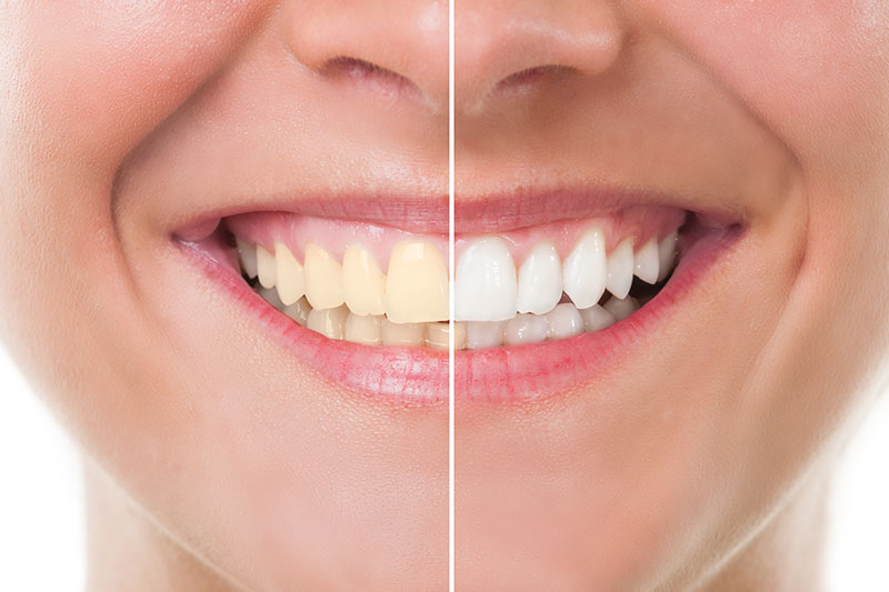 Teeth Whitening in Ontario